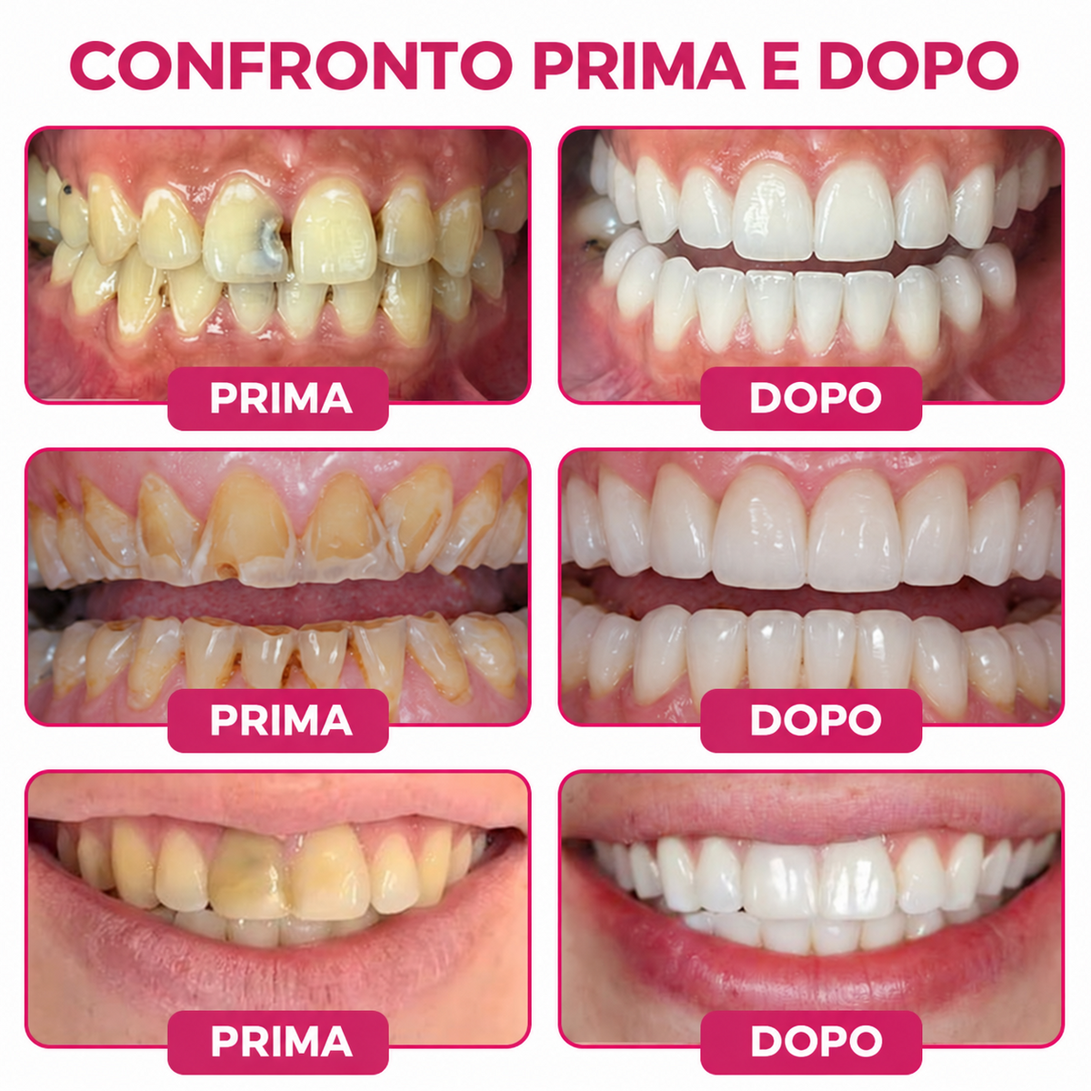 Glimmerly®💐💖Gel per la riparazione di cavità dentali DenPerm – Otturazione che riproduce lo smalto naturale