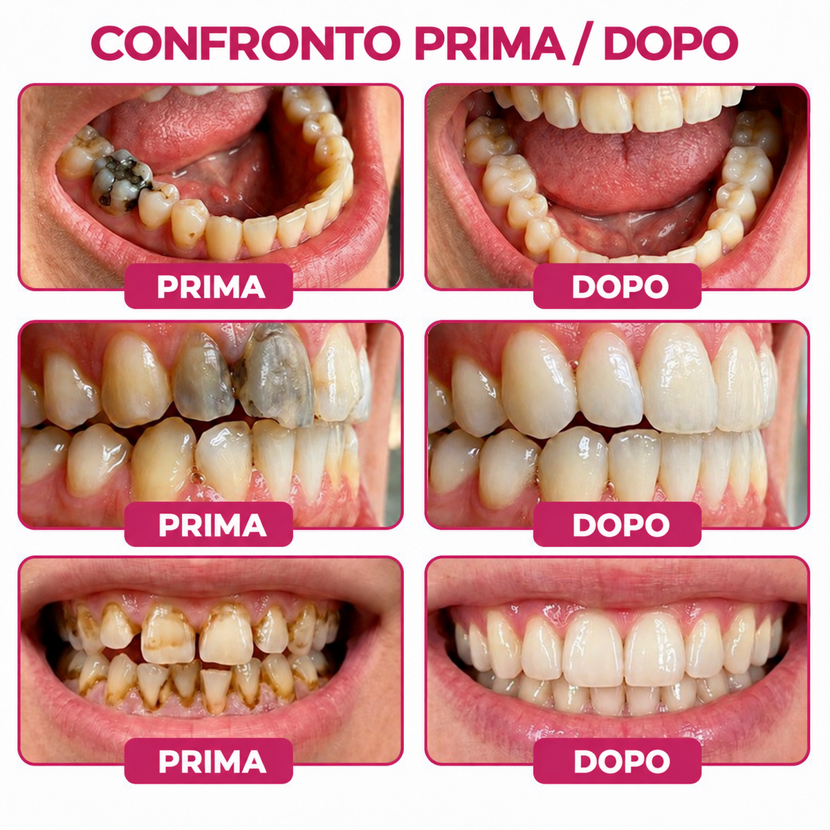Glimmerly®💐💖Gel per la riparazione di cavità dentali DenPerm – Otturazione che riproduce lo smalto naturale